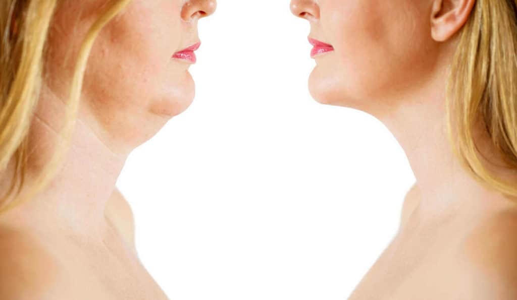 Double Chin treatment Suffolk before and after results