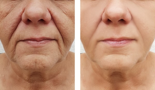 Learn more about Morpheus8 Treatment Suffolk today!