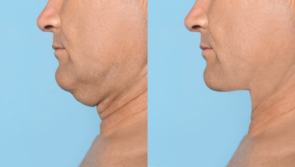 Which Non-Surgical Treatments Work Best for Jowls and Loose Skin Suffolk?
