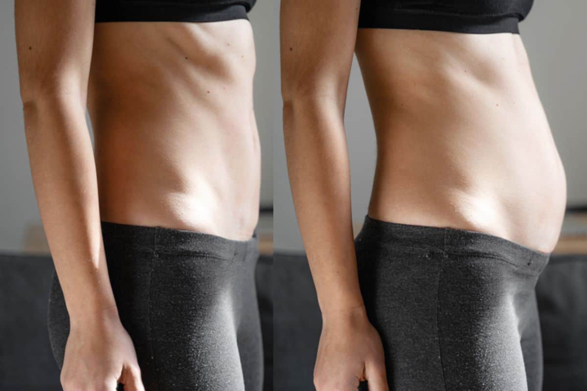 How long does diastasis recti take to improve Suffolk?