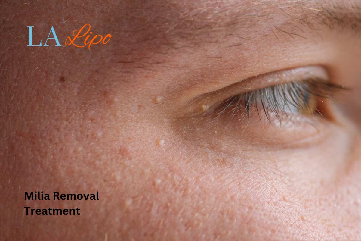 Cryopen Milia Removal: Is It the Easiest and Safest Option Suffolk?
