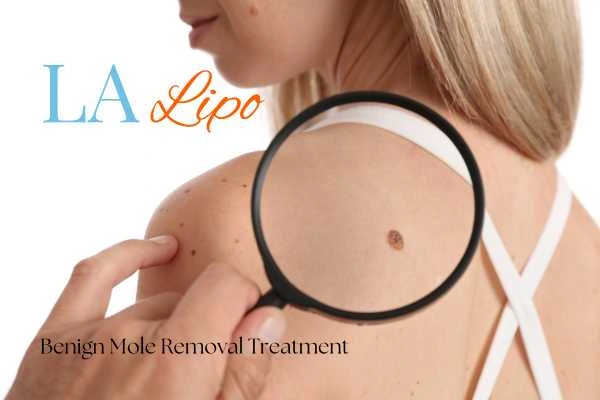 Woman having her inspection of blemish before mole removal Suffolk