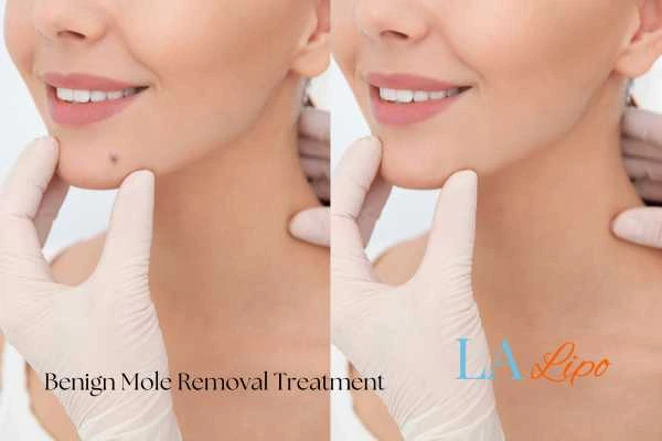 Before and after mole removal Suffolk treatment