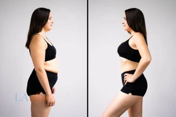 image of woman before and after results of LA-EMS Body Sculpting Suffolk to help treat Diastasis recti