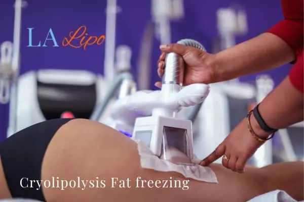 women getting fat freezing Suffolk