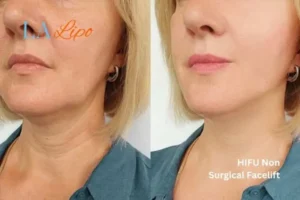 hi-fu for wrinkles Suffolk before and after results