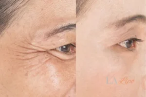 Before and after results of woman - HI-fu wrinkles reduction treatment Suffolk