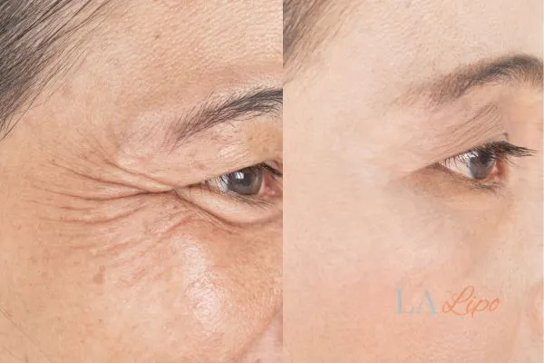 Before and after results of woman - HI-fu wrinkles reduction treatment Suffolk