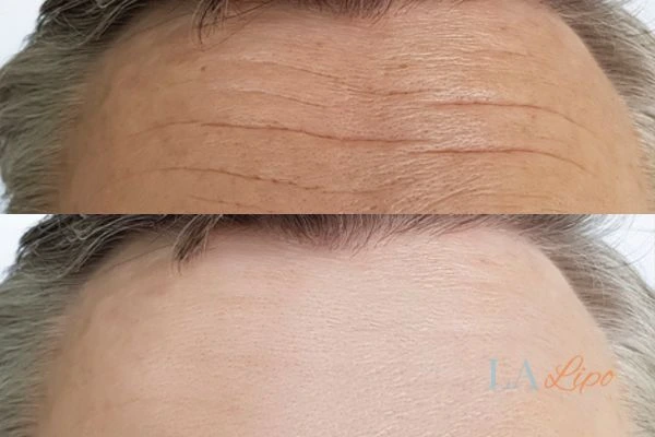 results of HIFU Suffolk on mans forehead to help reduce lines and wrinkles