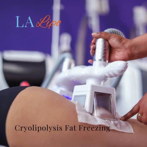 fat freezing - Cryolipolysis Suffolk