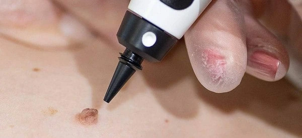 skin tag removal using cryopen Suffolk