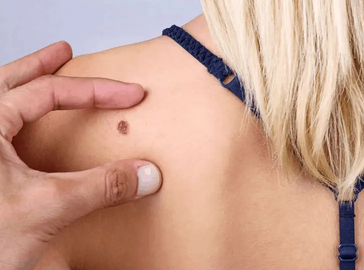woman having mole removal Suffolk consultation before treatment.