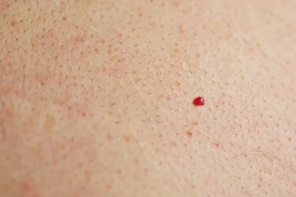 close up of a cherry angioma Suffolk