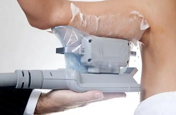 Picture of fat freezing Suffolk on the upper arms.