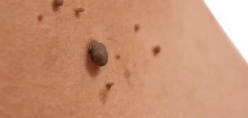 image of a skin tag Suffolk