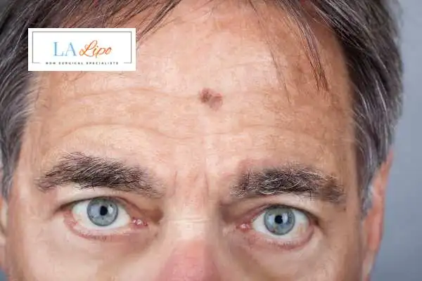 Solar Lentigo Removal Suffolk image of man with mark on his forehead