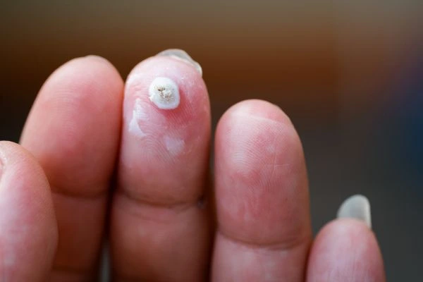 wart on person finger - cryotherapy to treat from LA LIPO Suffolk