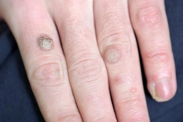 photo of warts on person hand - see wart removal Suffolk from LA LIPO