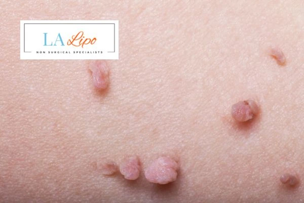 Does cryopen skin tag removal Suffolk hurt? Find out now call our team today!