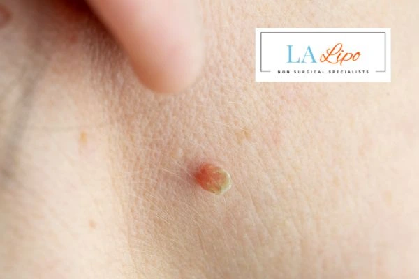 Book skin tag removal Suffolk today speak to our team now!