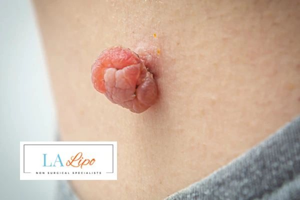 Interested in skin tag removal Suffolk? Concerned about the pain? Find out more today!