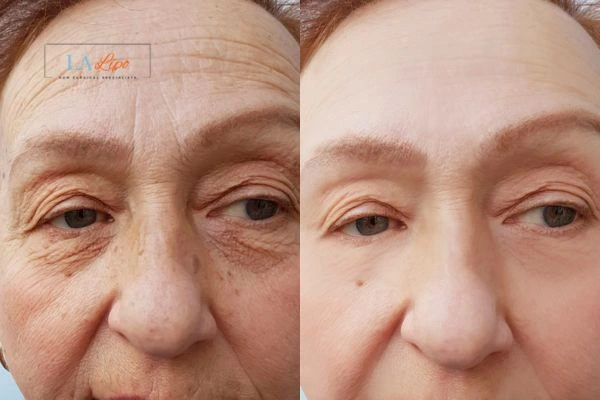The powerful benefits of Morpheus8 Treatment Suffolk - Call Our team today!