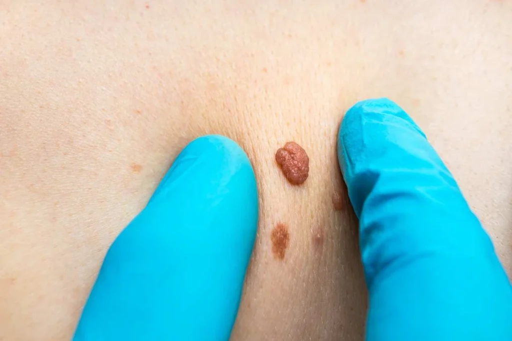LA LIPO Cryopen Lesion Removal Prices Suffolk