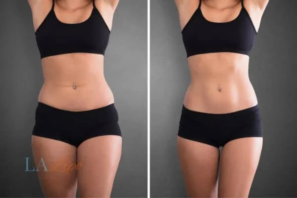 before and after results of non-surgical treatment to help a woman's body image and mental health Suffolk