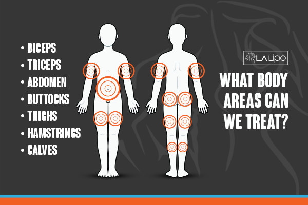 Diagram to show areas you can have LA-EMS Body Sculpting Treatment Suffolk