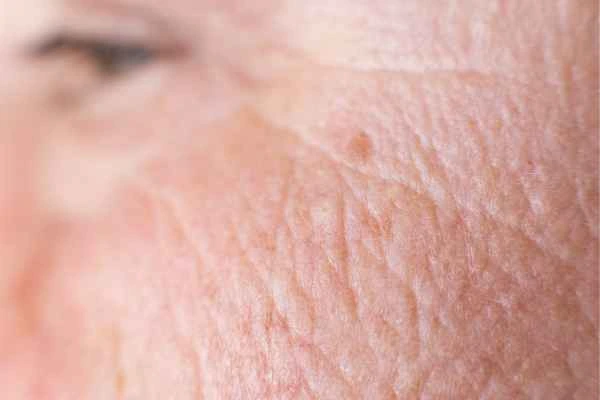 close up picture of a woman's face showing an age spot Suffolk