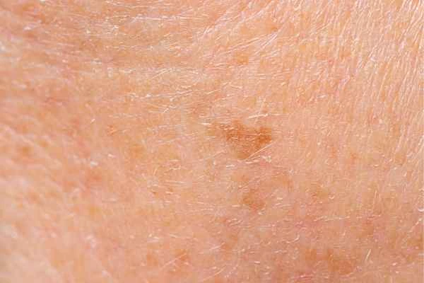 close up picture of age spots Suffolk