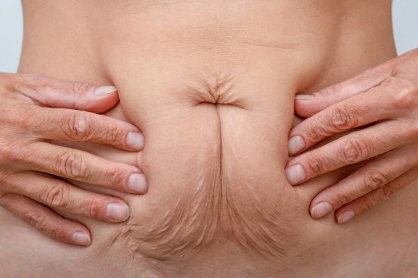 Image of a woman's stomach with loose skin - example of skin tightening Suffolk options