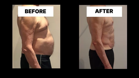 What Symptoms Can Diastasis Recti Cause in Men? Weak Core, Back Pain and Poor Posture Suffolk